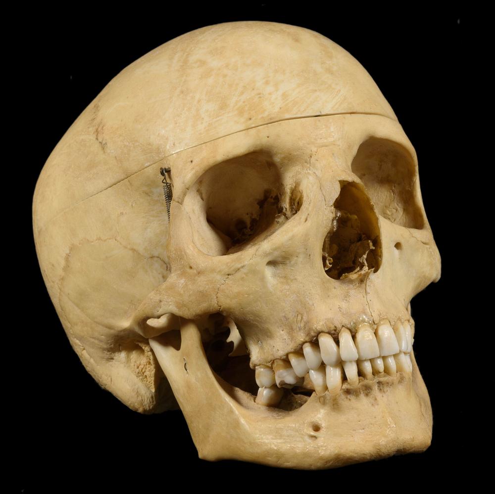 MEDICAL TEACHING SKULL WITH THREE VERTEBRAE - RELICS
