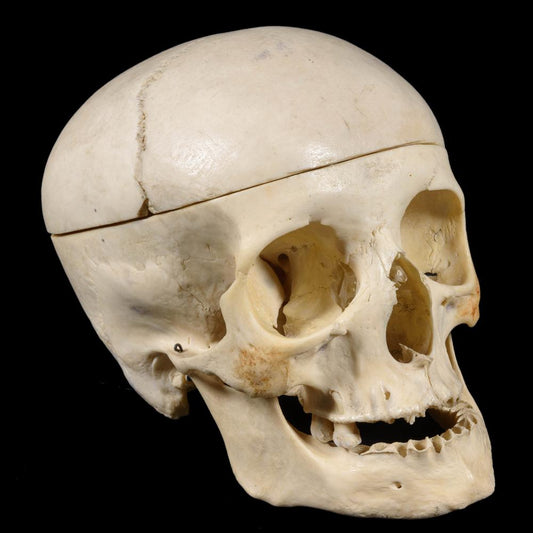 MEDICAL STUDY SKULL WITH DEFORMATION - RELICS