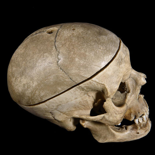 TREPANNED HUMAN SKULL – ANTIQUE ANATOMICAL SPECIMEN - RELICS